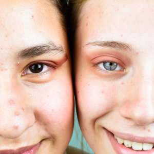 Jongen en meisje met acne en puistjes – acnebehandeling bij Huidpraktijk Noordwijk