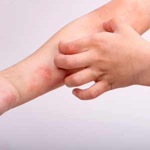 Kind, man en vrouw met eczeem en een zeer droge, rode en schilferige huid – Huidpraktijk Noordwijk
