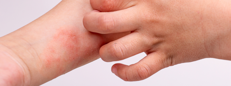 Kind, man en vrouw met eczeem en een zeer droge, rode en schilferige huid – Huidpraktijk Noordwijk